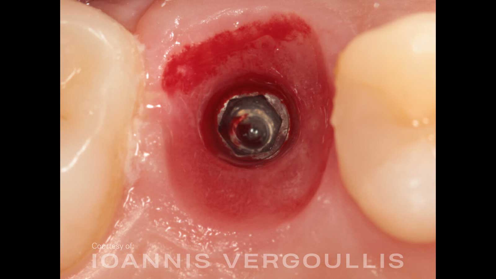 A simple Cervico case.