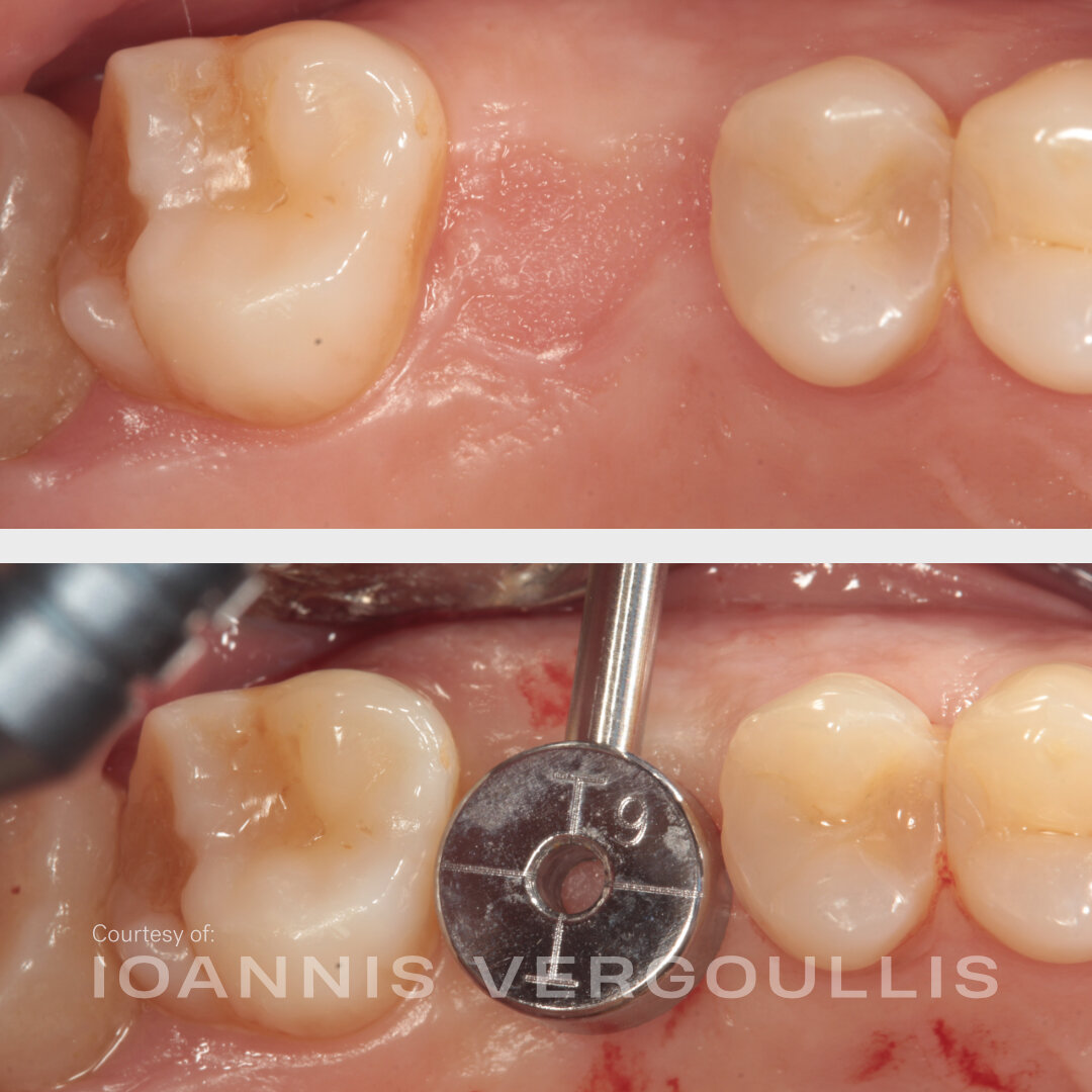 Cervico Guide evaluating an implant site