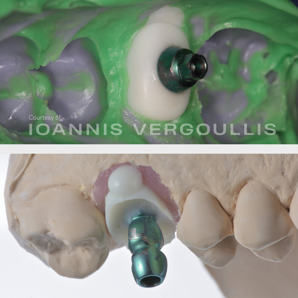 A simple Cervico case: bread-and-butter dentistry