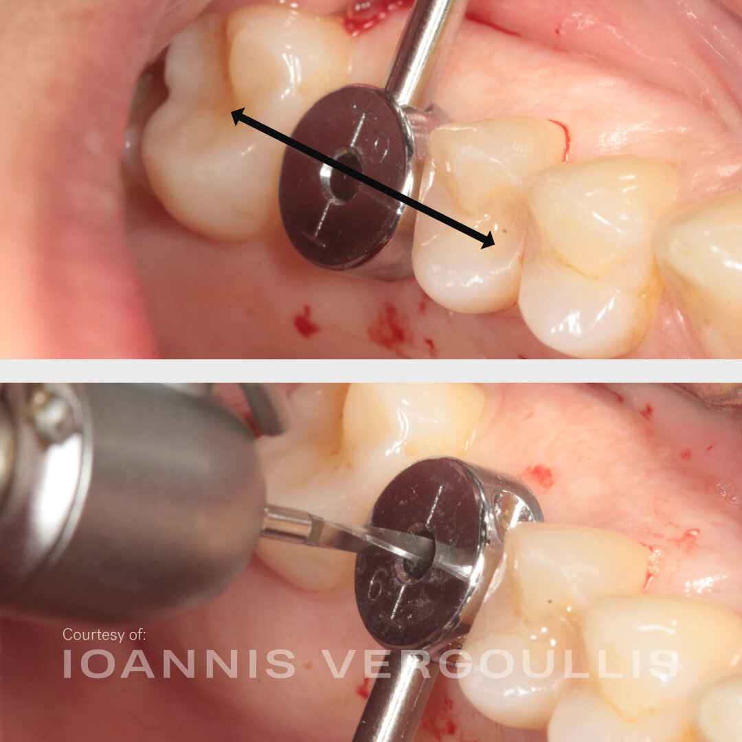 A simple Cervico case: bread-and-butter dentistry