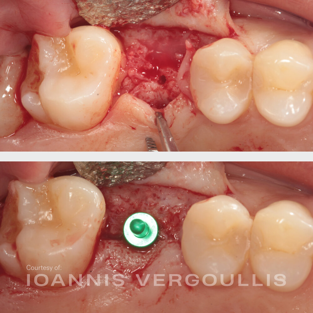 A simple Cervico case: bread-and-butter dentistry
