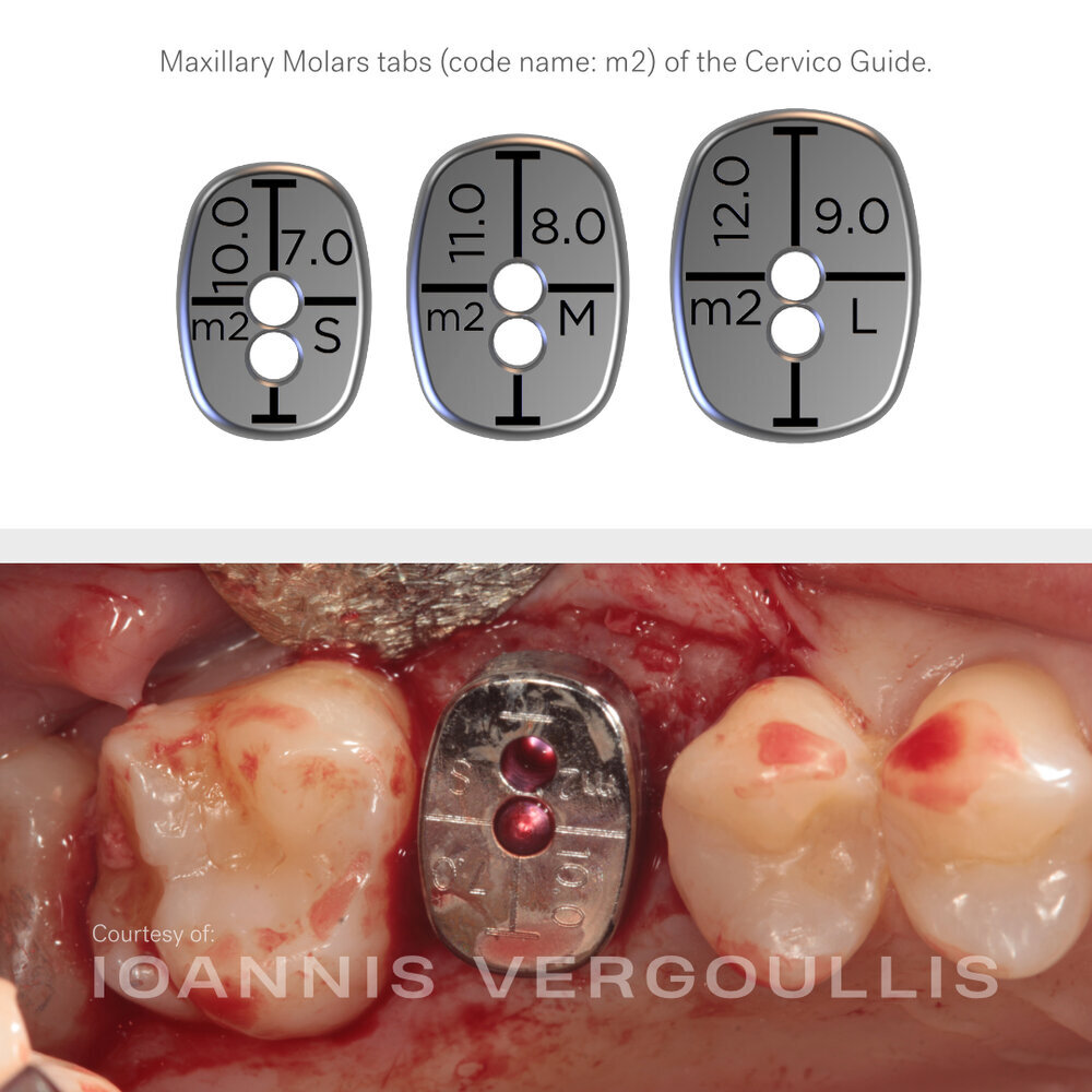 A simple Cervico case: bread-and-butter dentistry