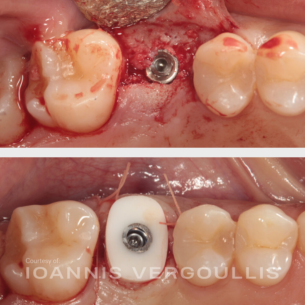 A simple Cervico case: bread-and-butter dentistry