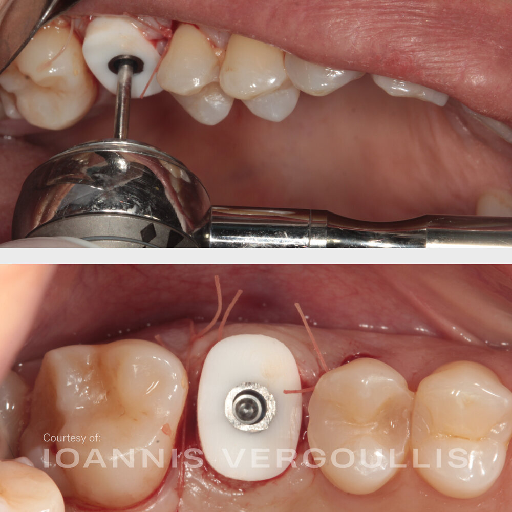 A simple Cervico case: bread-and-butter dentistry