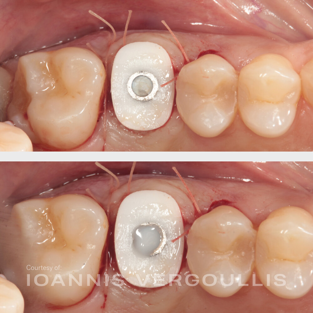 A simple Cervico case: bread-and-butter dentistry