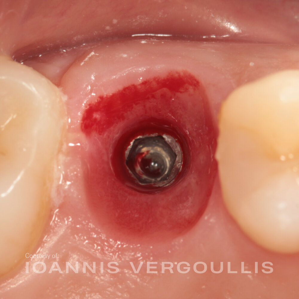 Peri-implant soft tissue after a custom healing abutment