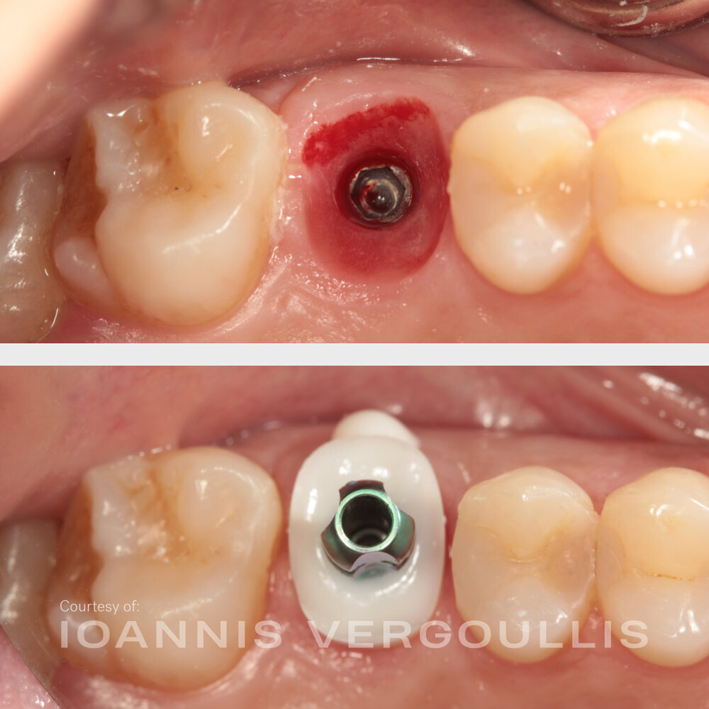 A simple Cervico case: bread-and-butter dentistry
