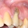 Restoring a site with severe recession.