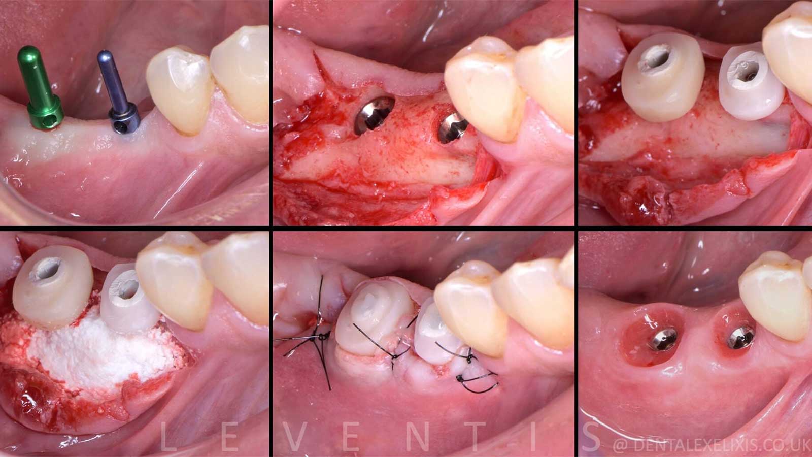 The Cervico system on adjacent molars.