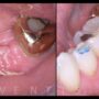 Lower molar early implant placement.