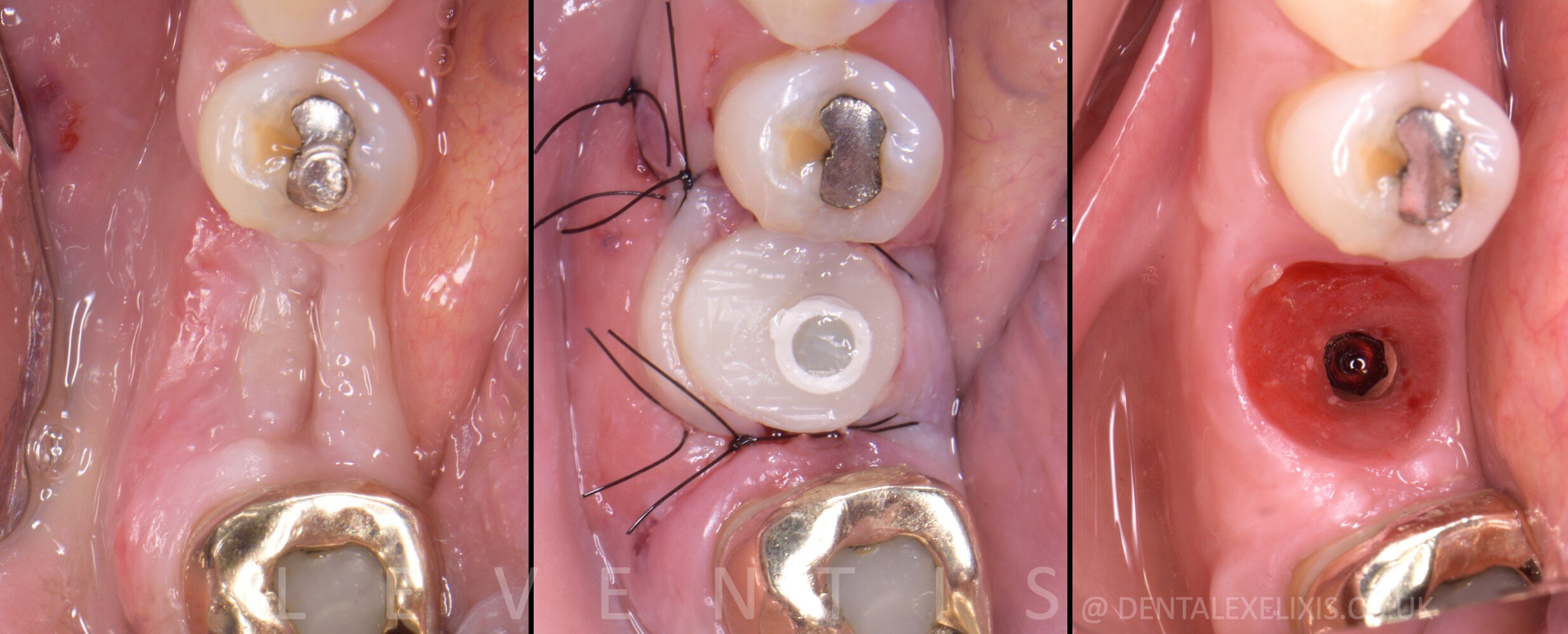 Early placement at four weeks, and the soft tissue redesigned without a graft