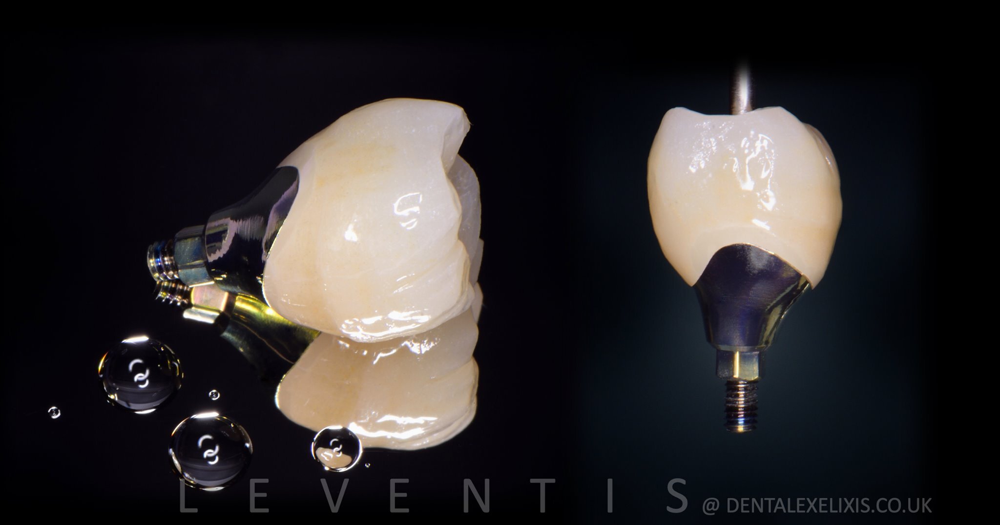 Early placement at four weeks, and the soft tissue redesigned without a graft