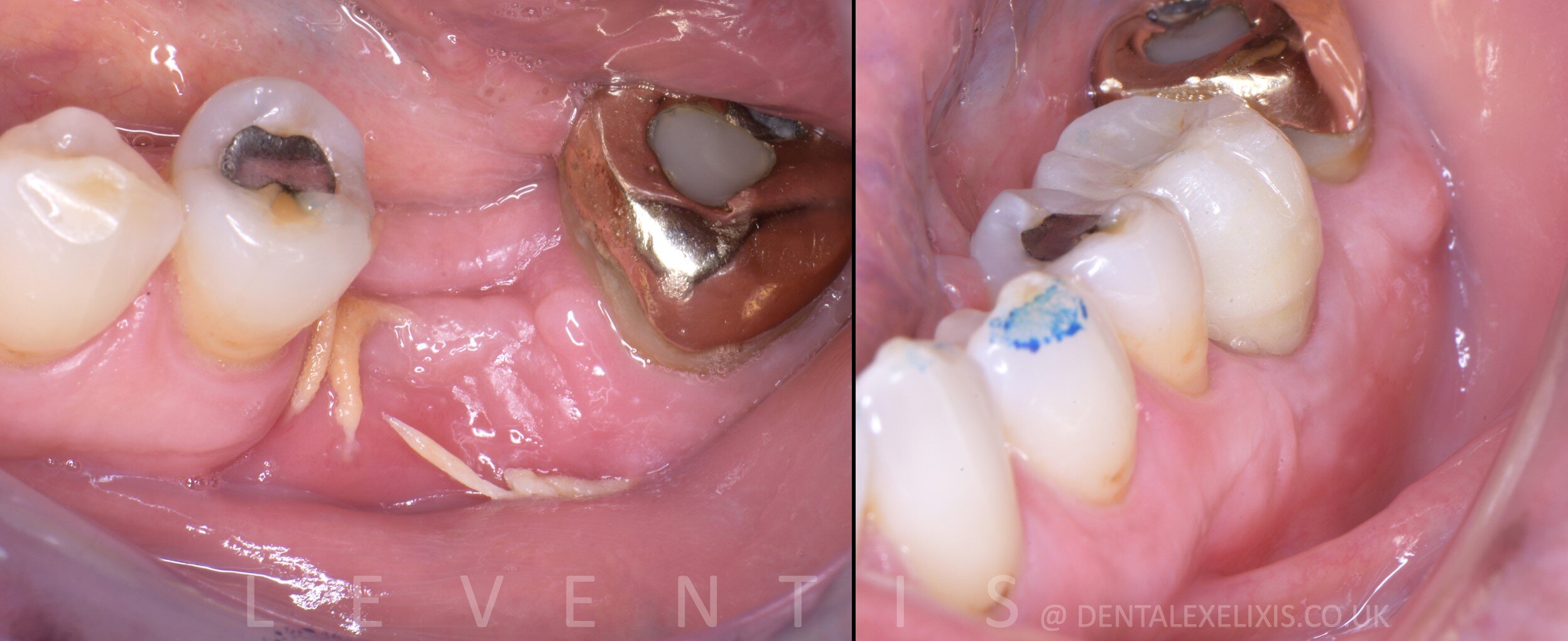 Custom healing abutment case: lower molar before and after