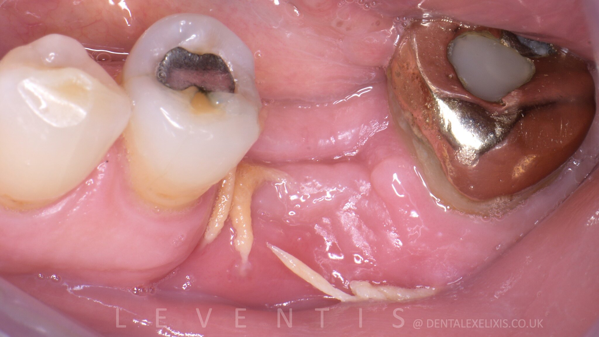 Initial situation, four weeks after extraction of the lower left first molar.
