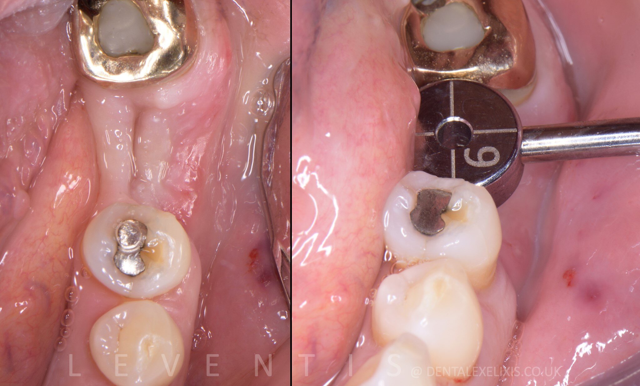 Early placement at four weeks, and the soft tissue redesigned without a graft