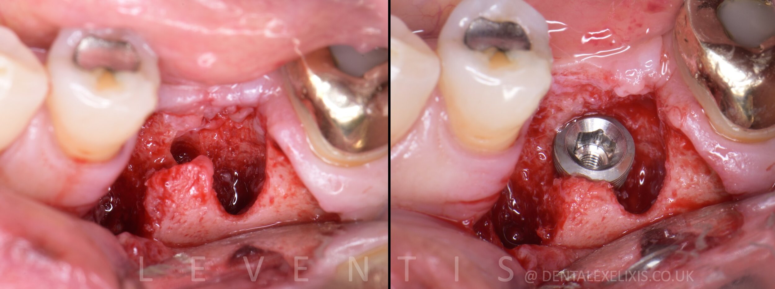 Early placement at four weeks, and the soft tissue redesigned without a graft