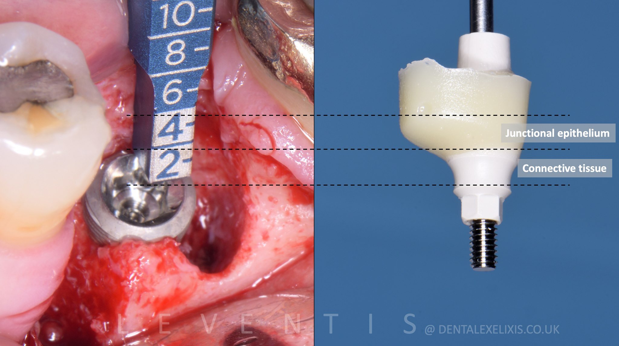 Early placement at four weeks, and the soft tissue redesigned without a graft