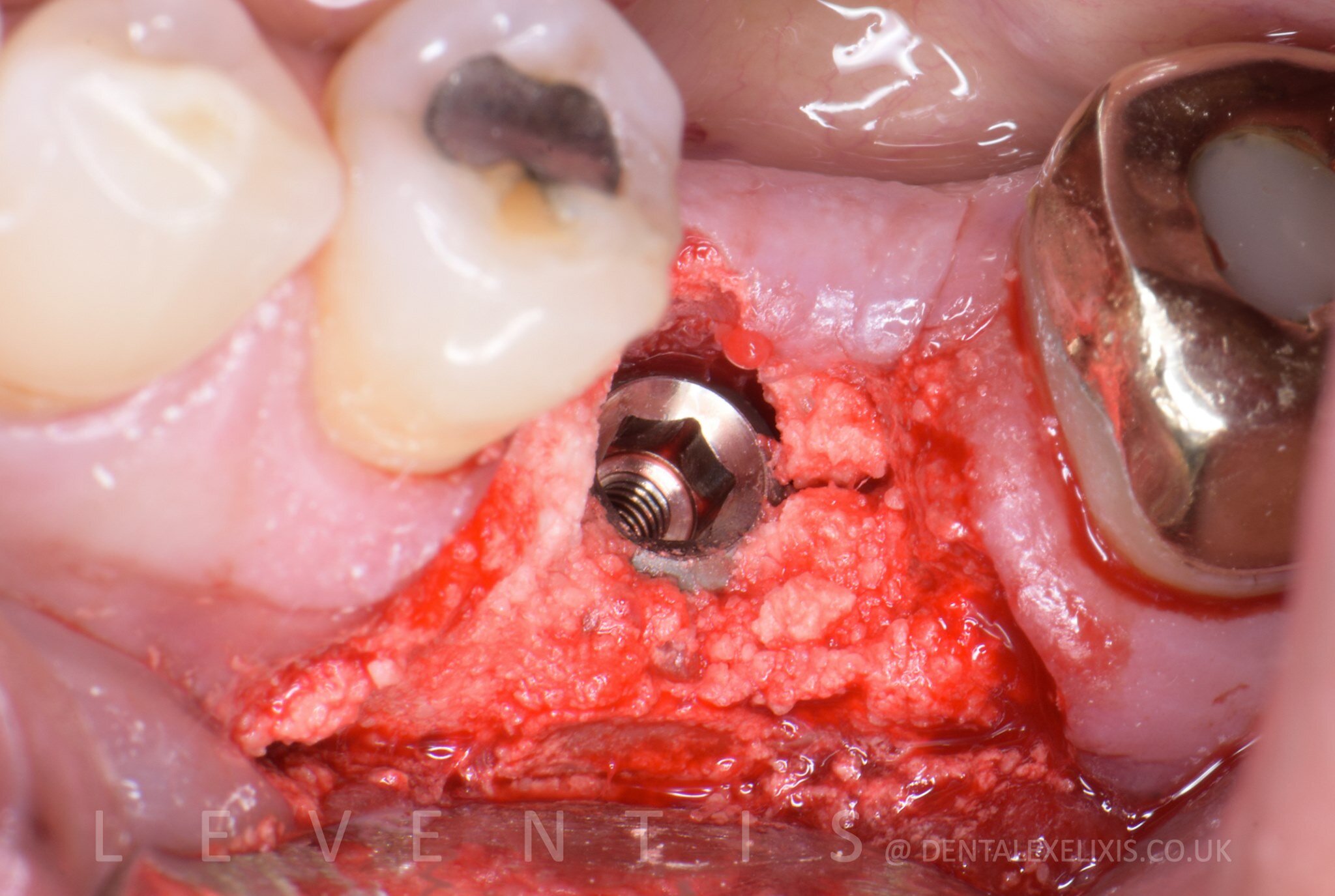Grafted implant site before a sealing socket abutment