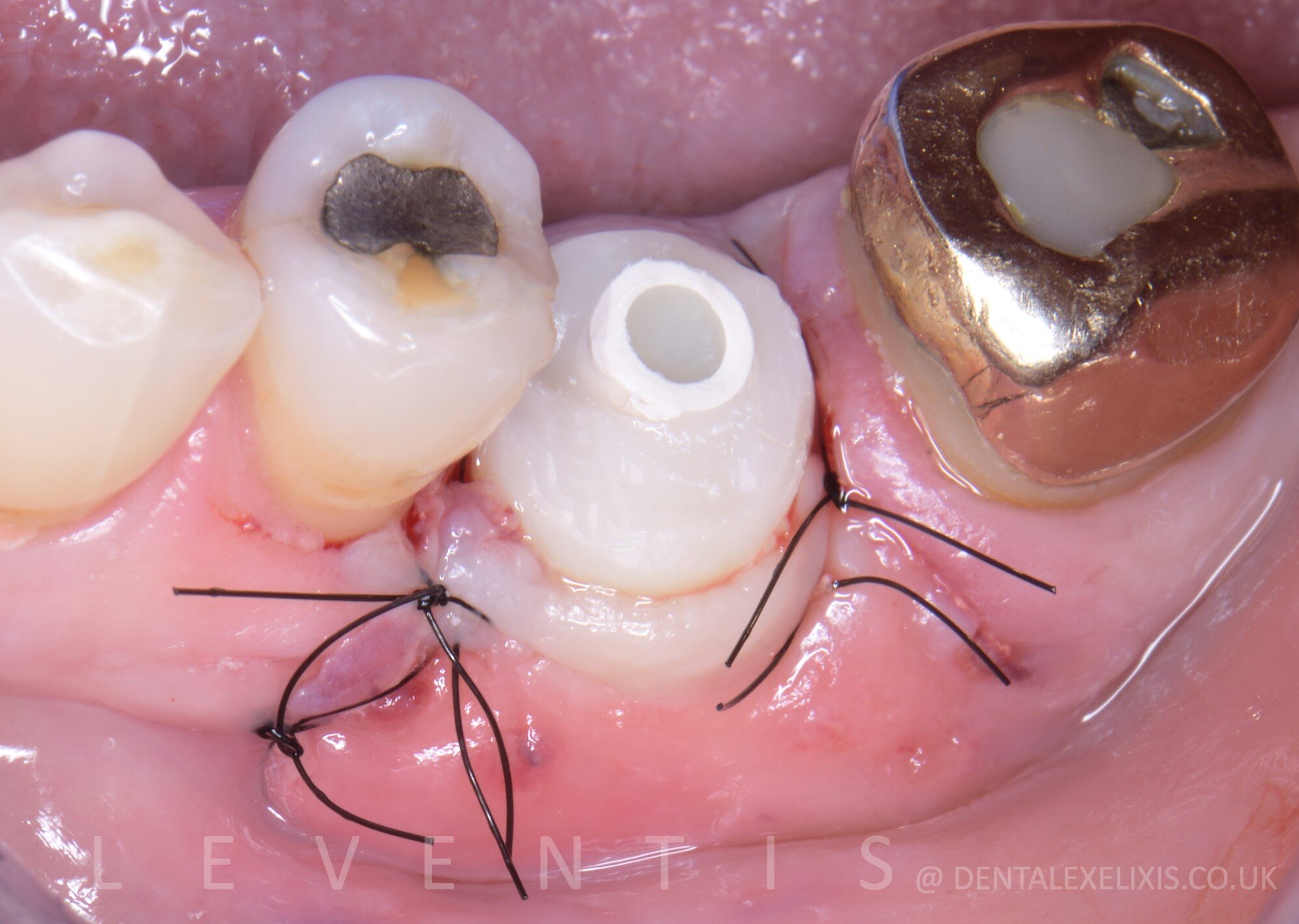 Custom healing abutment sealing a grafted implant site