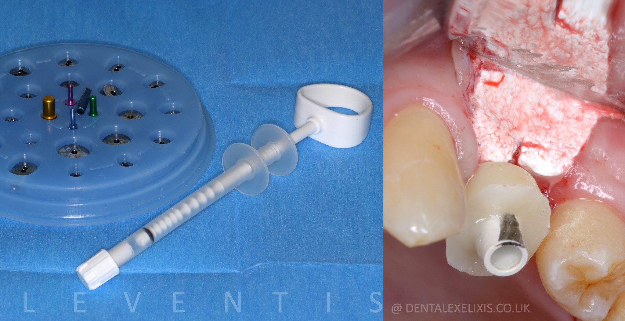 A deficient buccal site, treated without a soft-tissue graft