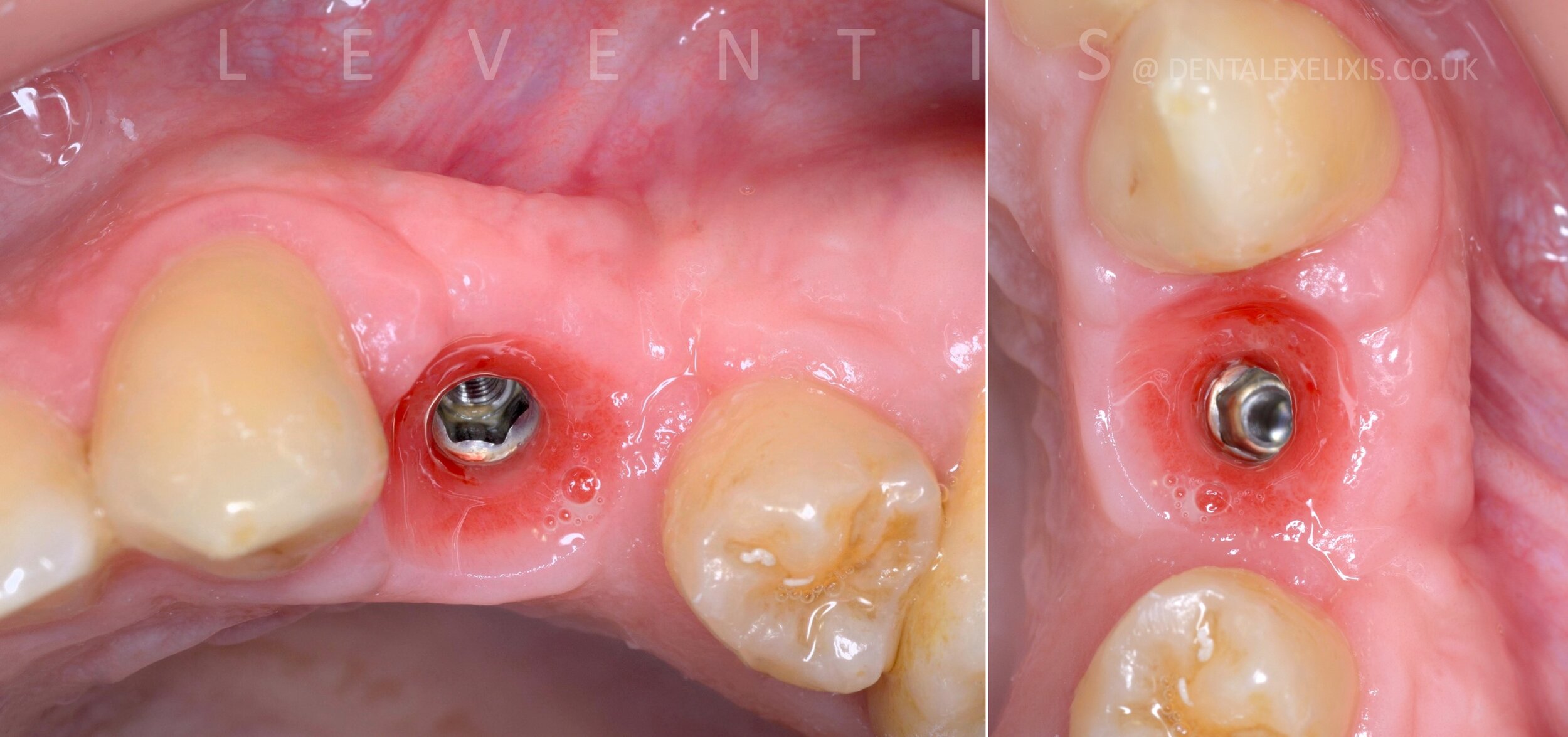 Emergence profile after a custom healing abutment in a site with recession