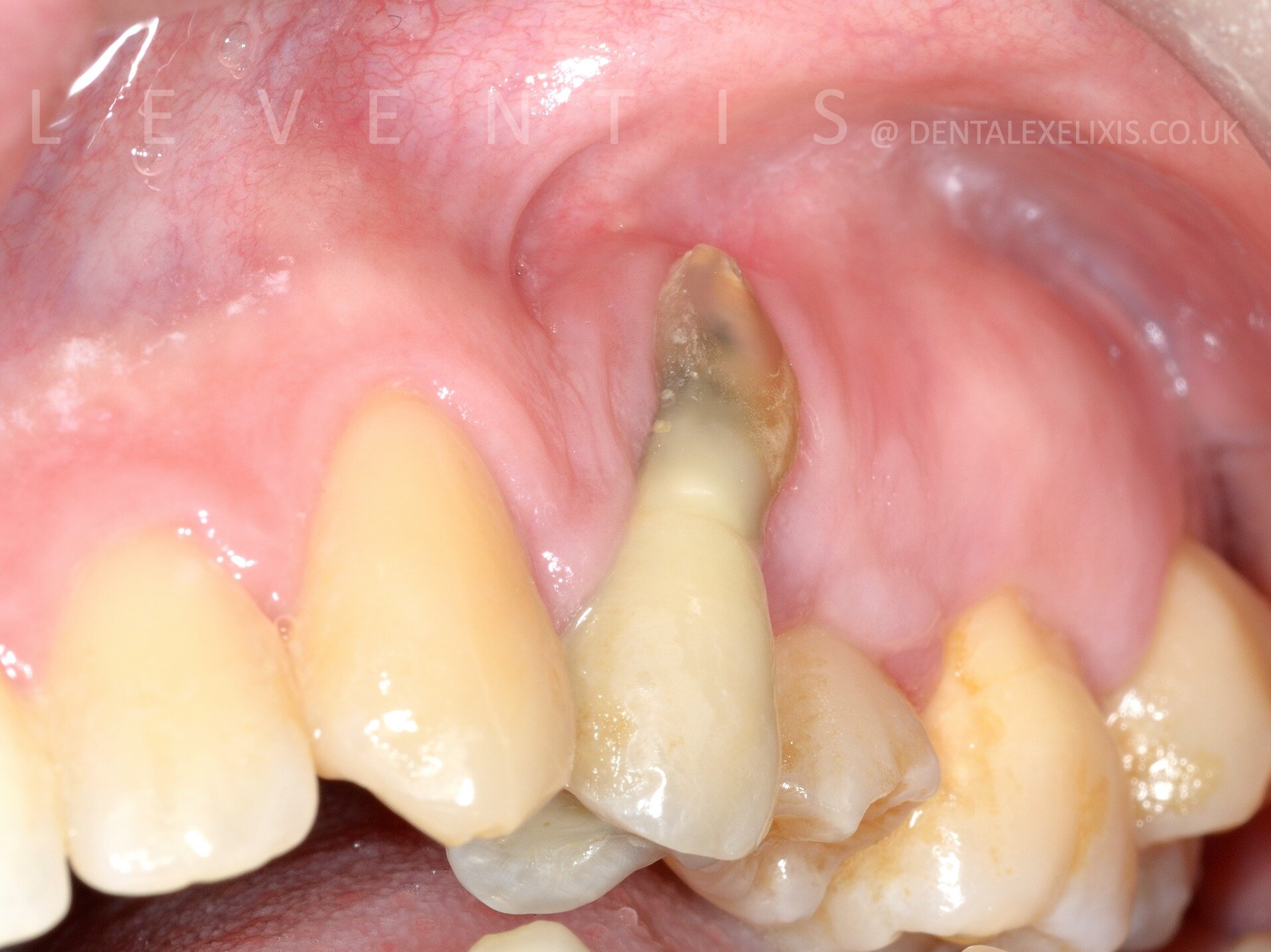 Initial situation: infection, mobility and severe buccal recession at the failing tooth.