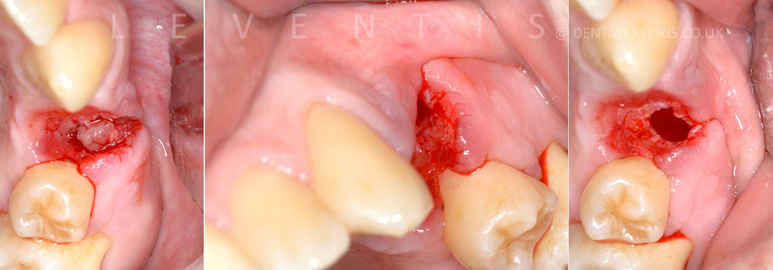 A deficient buccal site, treated without a soft-tissue graft