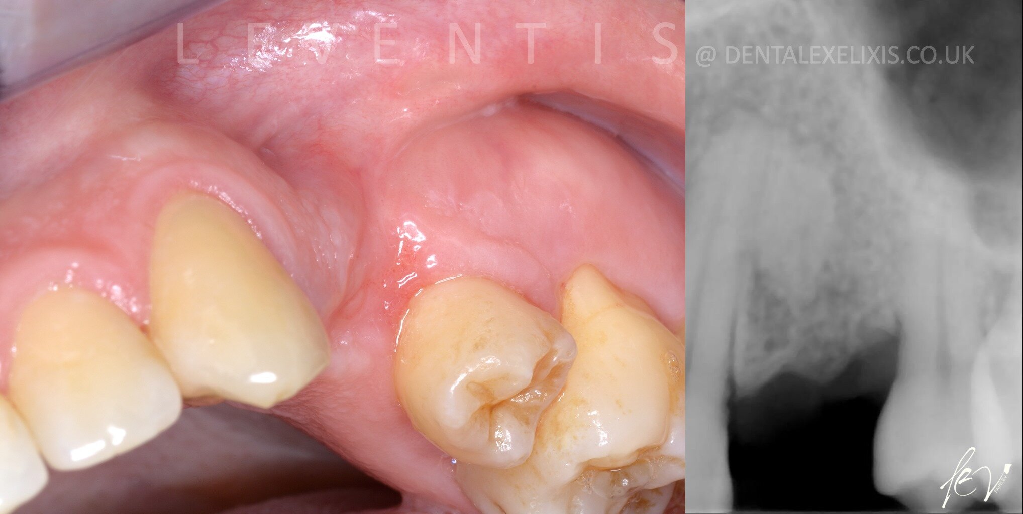 A deficient buccal site, treated without a soft-tissue graft