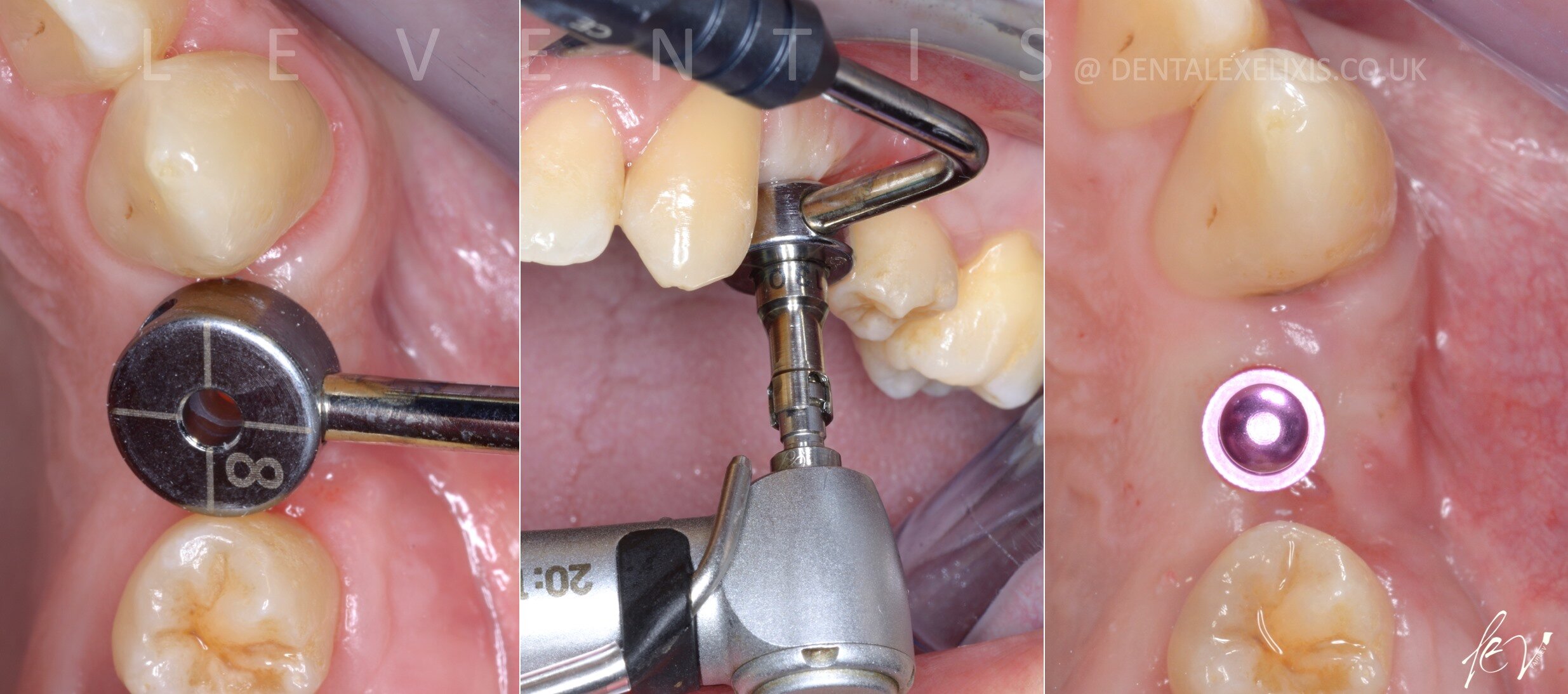 A deficient buccal site, treated without a soft-tissue graft
