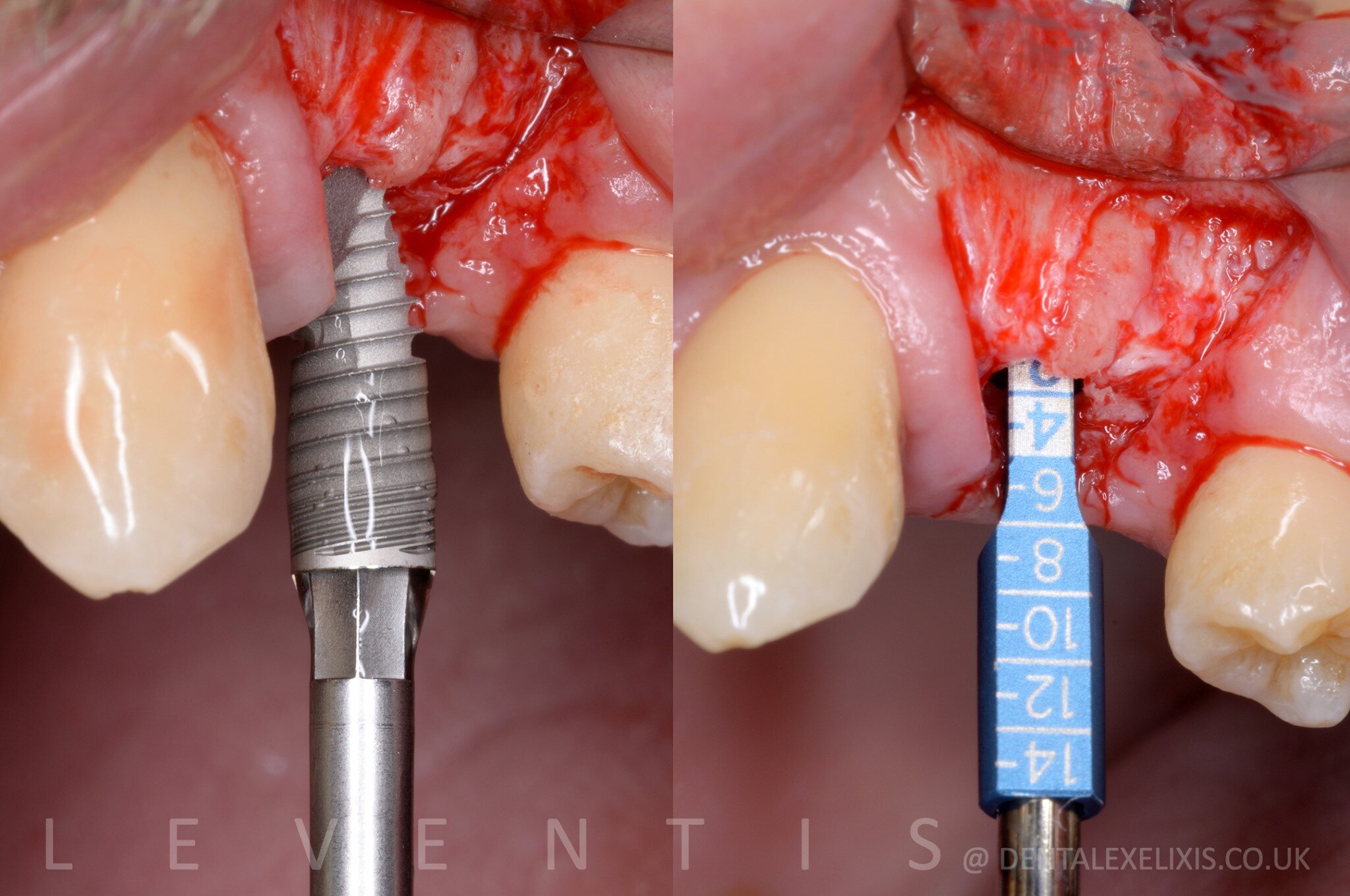 A deficient buccal site, treated without a soft-tissue graft