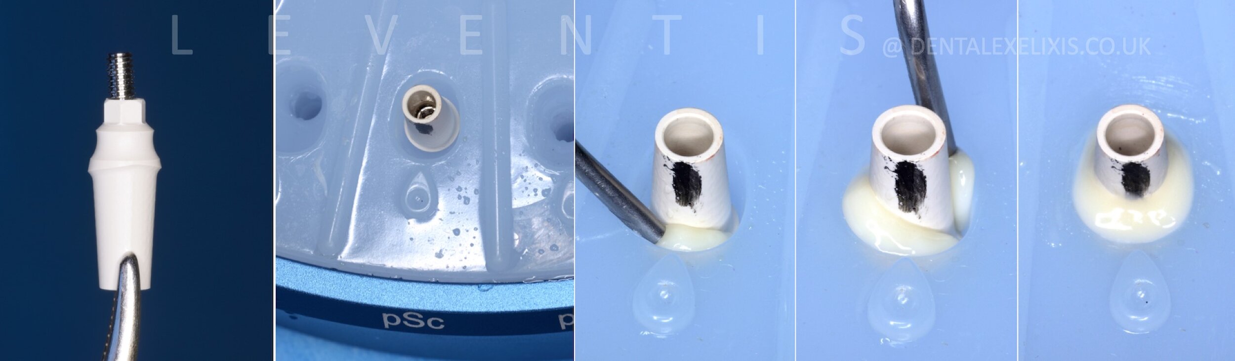 A deficient buccal site, treated without a soft-tissue graft