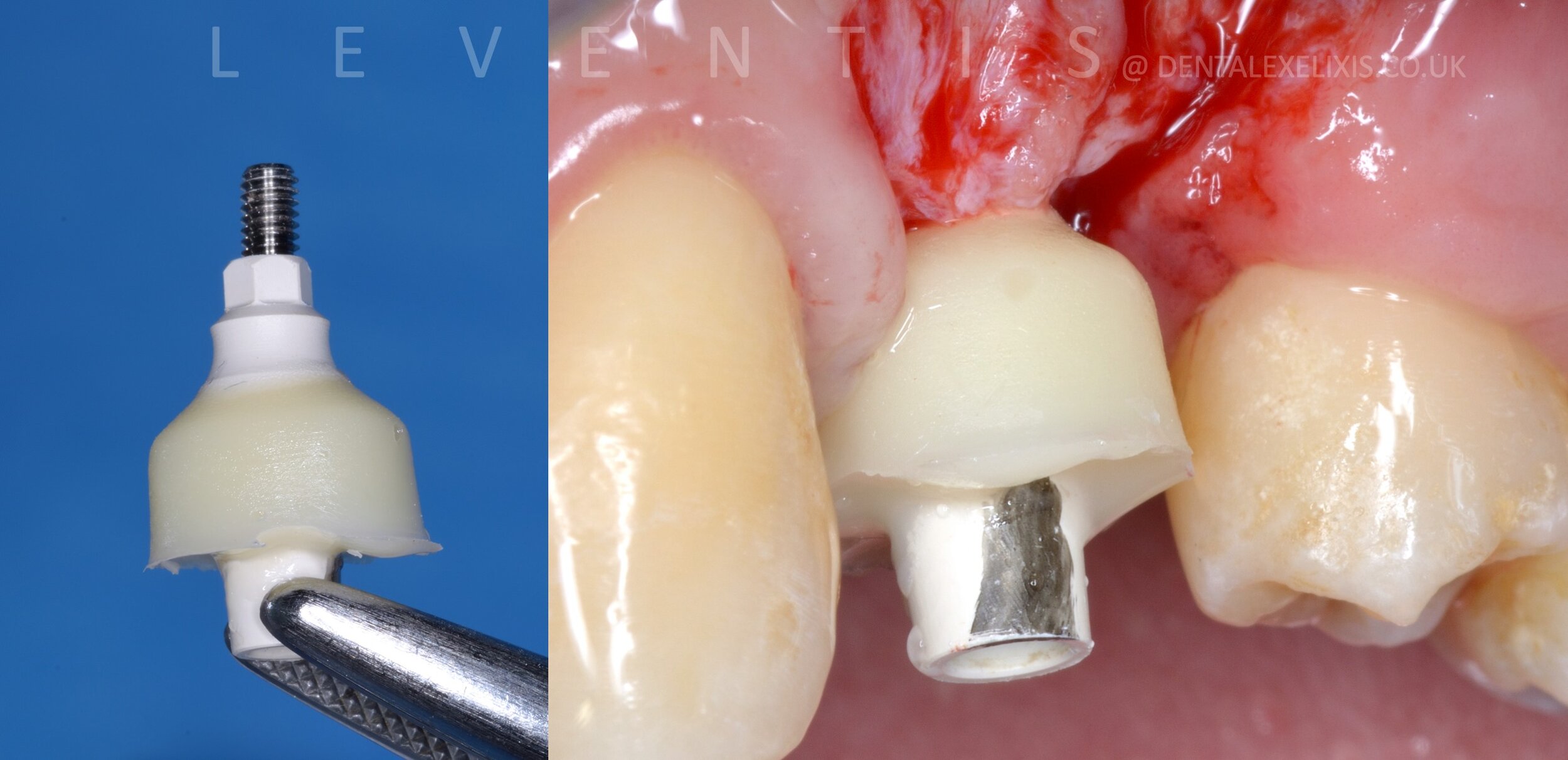 A deficient buccal site, treated without a soft-tissue graft