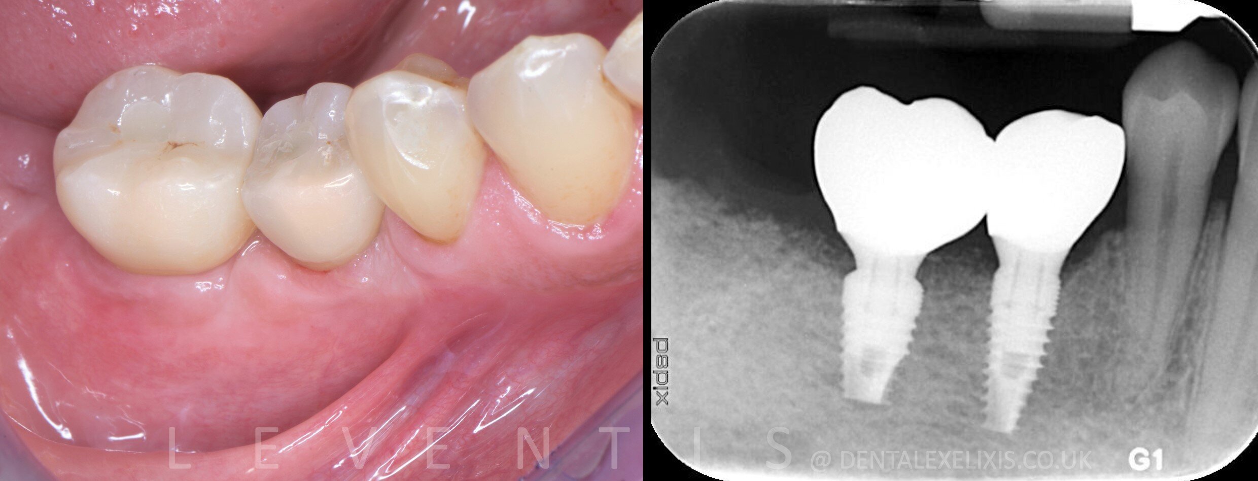 A premolar and a molar, flapless pilot through the Guide, no membranes
