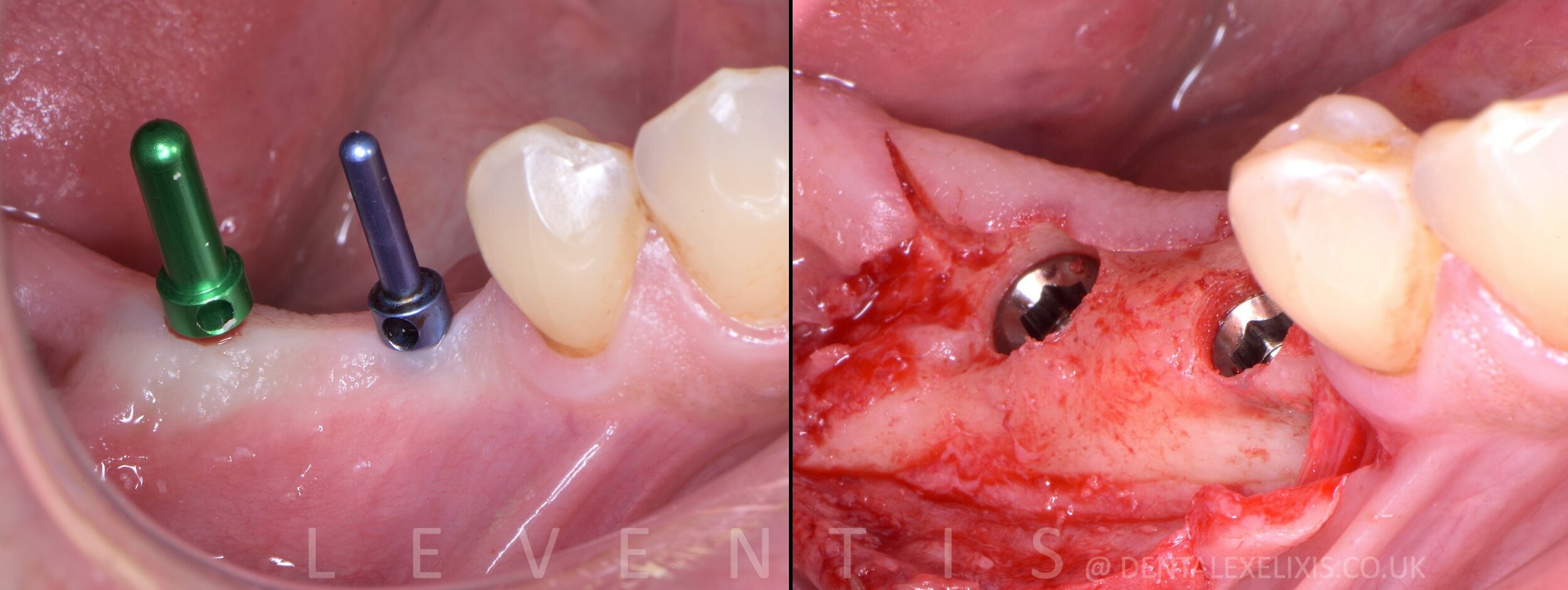 A premolar and a molar, flapless pilot through the Guide, no membranes