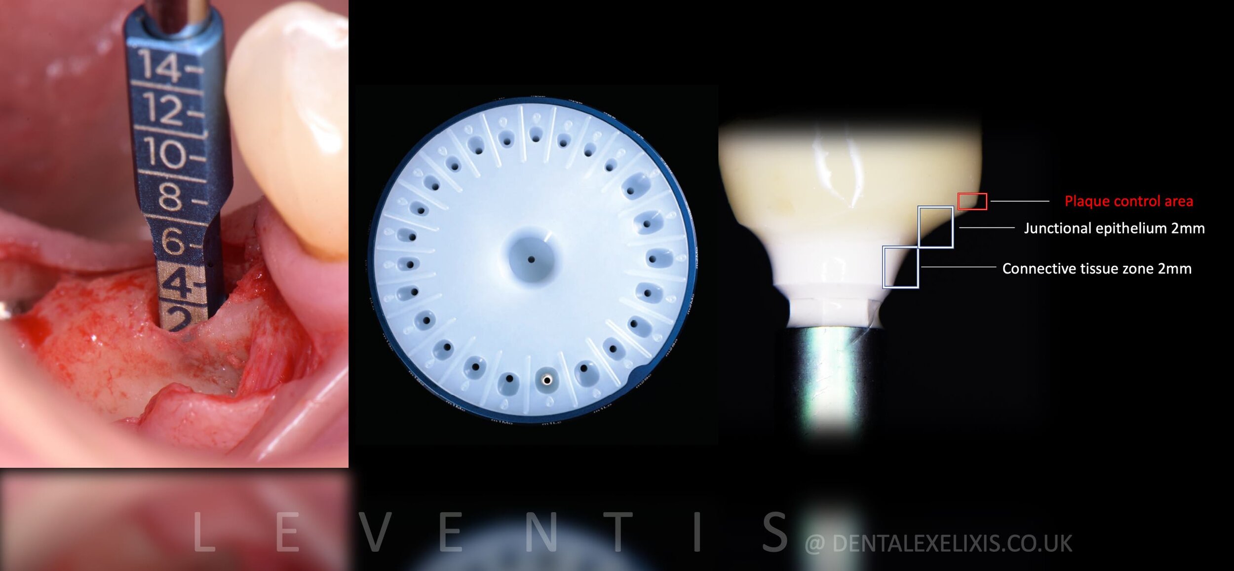 A premolar and a molar, flapless pilot through the Guide, no membranes