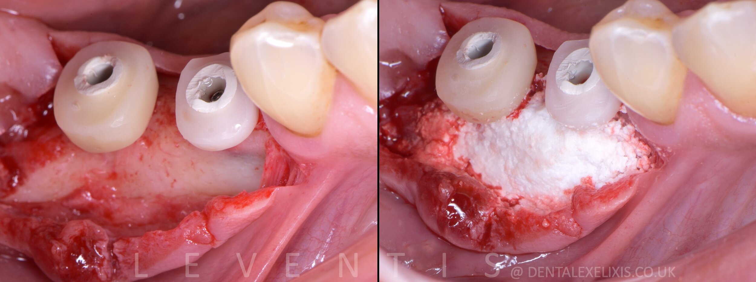 Custom healing abutments sealing a grafted molar site, no membrane
