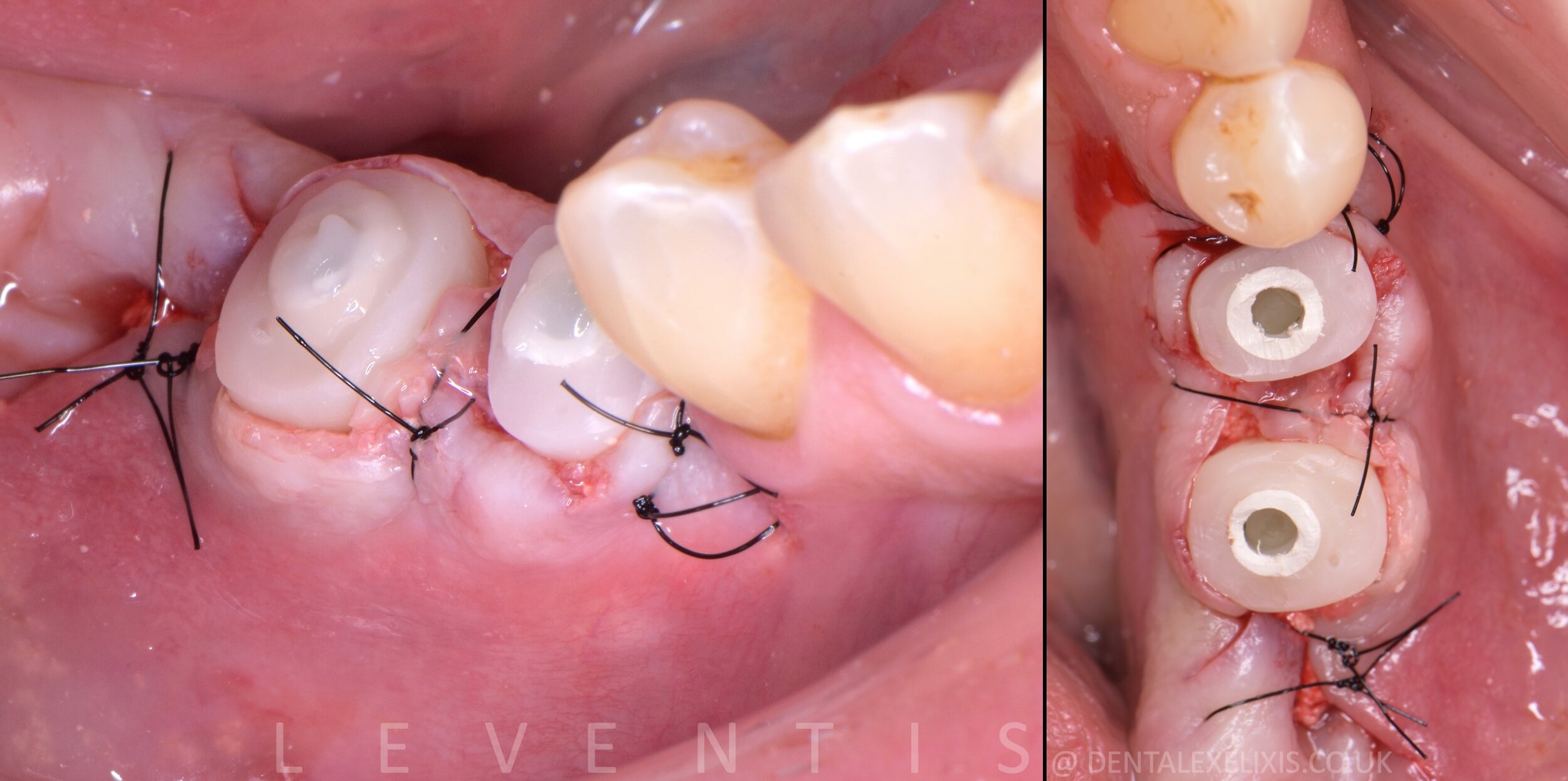 A premolar and a molar, flapless pilot through the Guide, no membranes