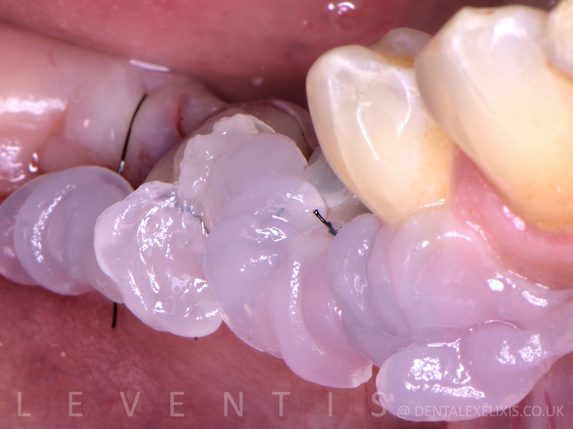 A premolar and a molar, flapless pilot through the Guide, no membranes