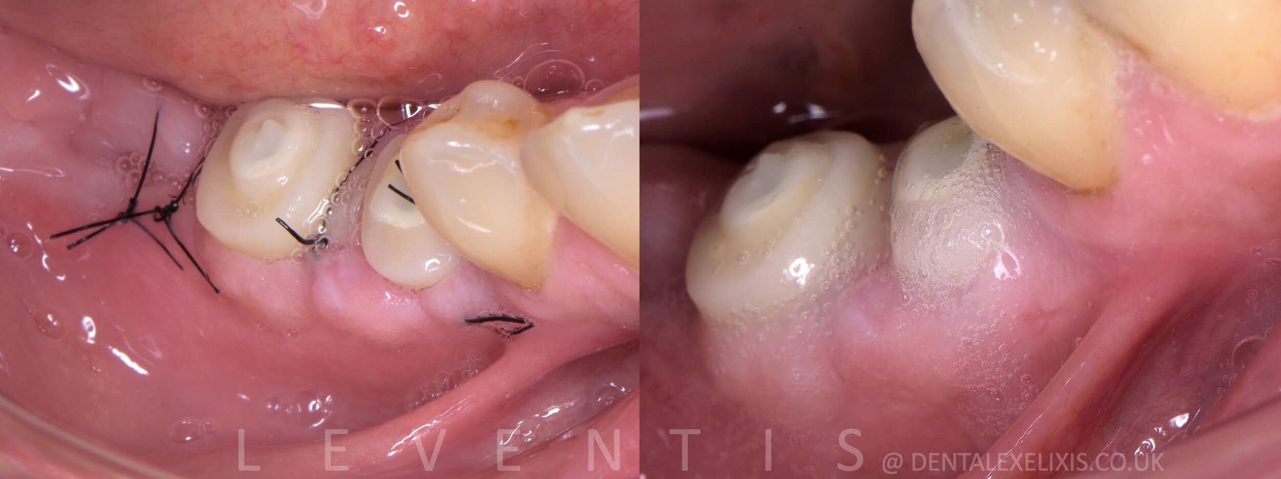 A premolar and a molar, flapless pilot through the Guide, no membranes