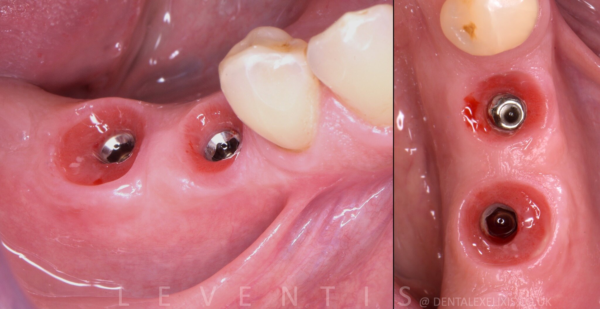 Emergence profiles at three months after sealing socket abutments