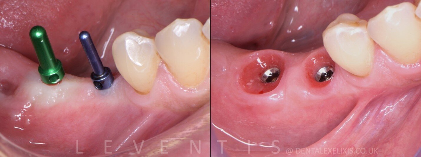 Adjacent molar implants with custom healing abutments, before and after