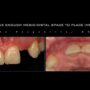 Post ortho treatment with limited mesio-distal space.