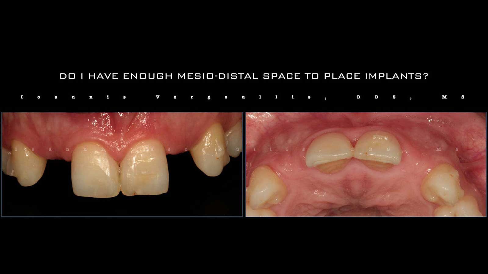 Post ortho treatment with limited mesio-distal space.