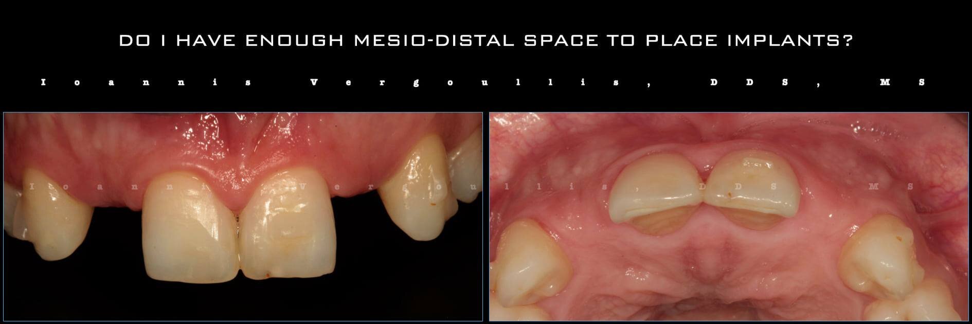 Do I have enough mesio-distal space to place implants? Post-orthodontic situation, lateral incisors missing.