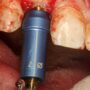 VPI Pilot drill kit in action