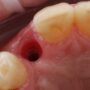Anterior implant with Cervico