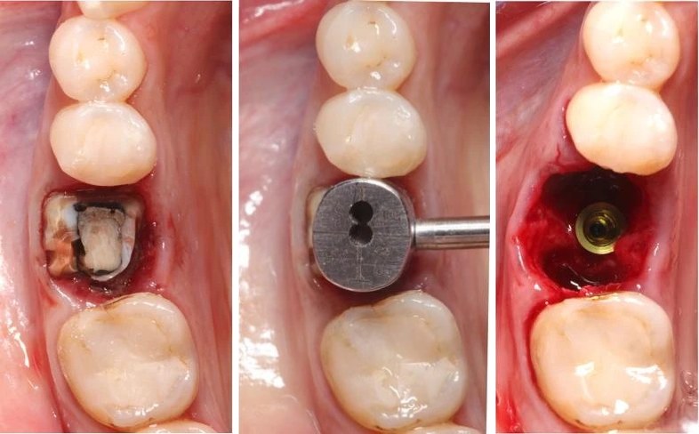 Immediate implant placement in a molar socket: failing tooth, Guide tab, implant in the socket