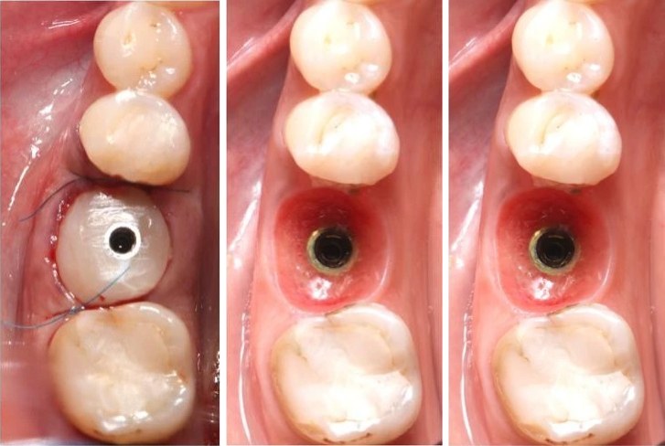 Sealing socket abutment in composite: sealed socket, healing, emergence profile