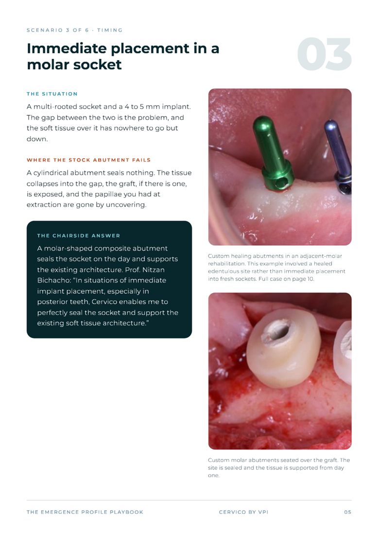 Scenario page: immediate placement in a molar socket