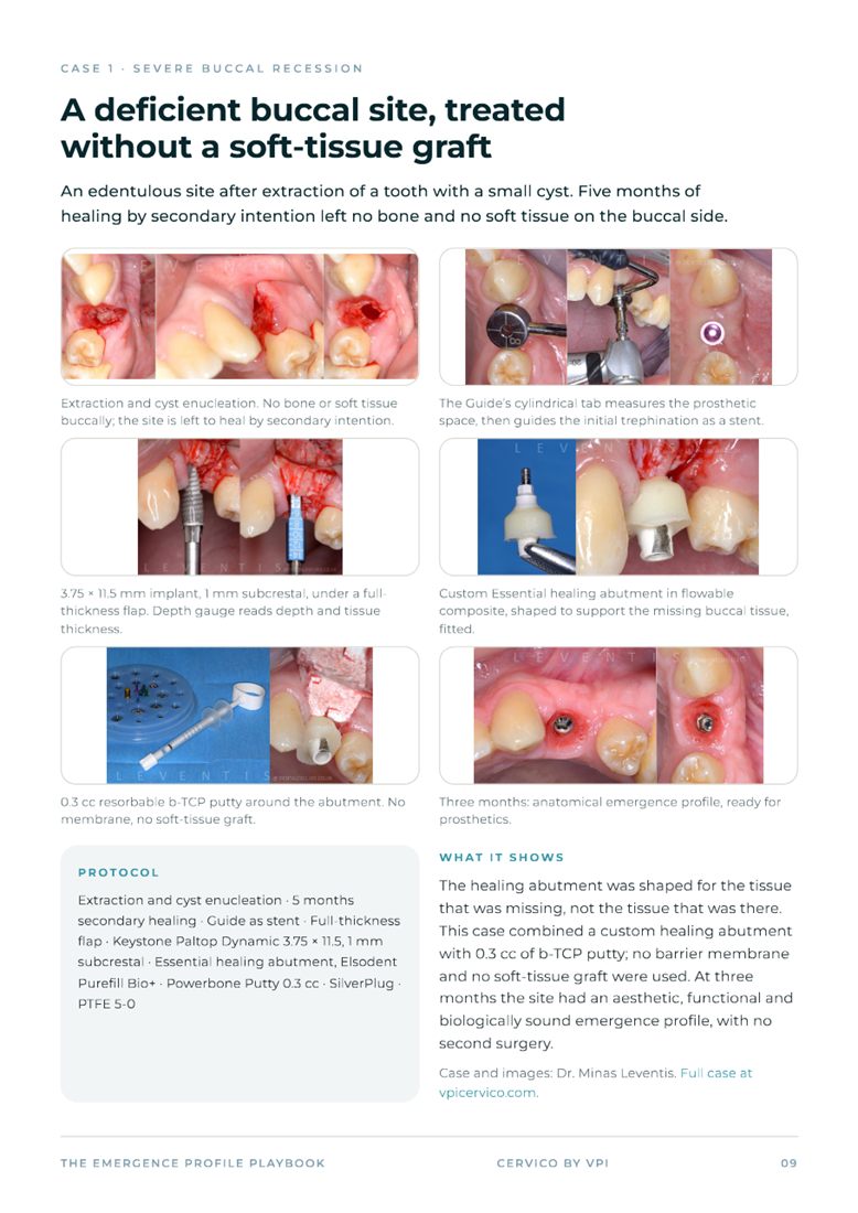 Case page: a deficient buccal site treated without a soft-tissue graft